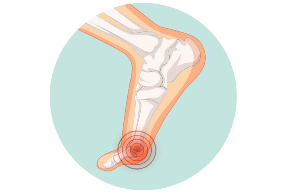 Arthritis / Neuroma