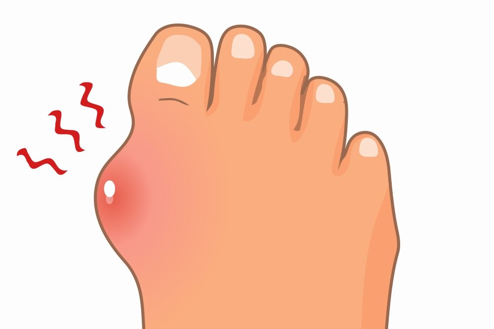 Gout
