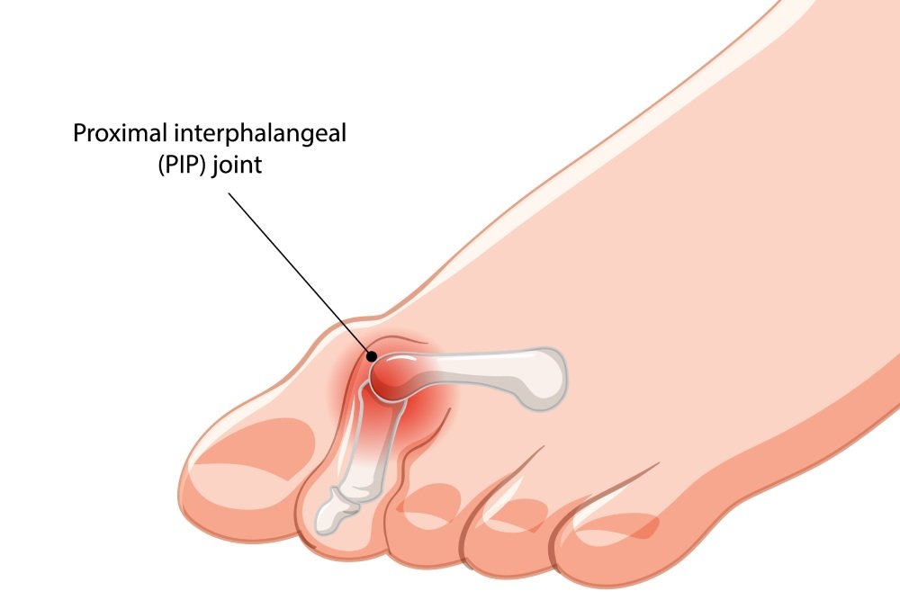 Hammer toe